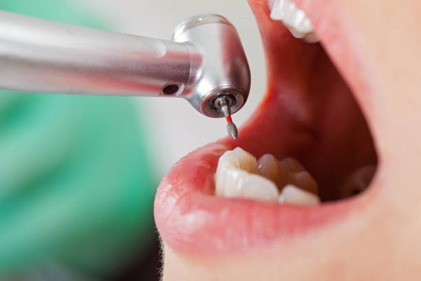 Best Emergency Tooth Extraction in Atwater, MN